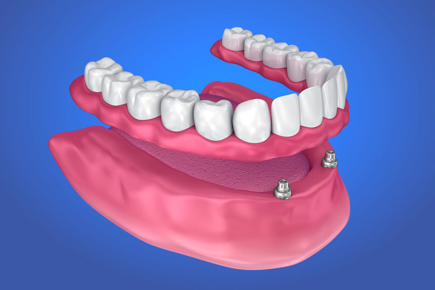 Klikprothese op implantaten
